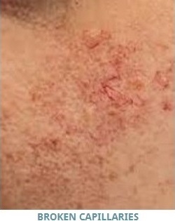 Broken Capillaries Treatment Guelph